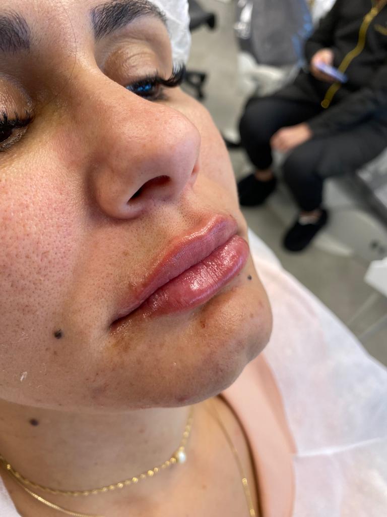Depois — Preenchimento labial