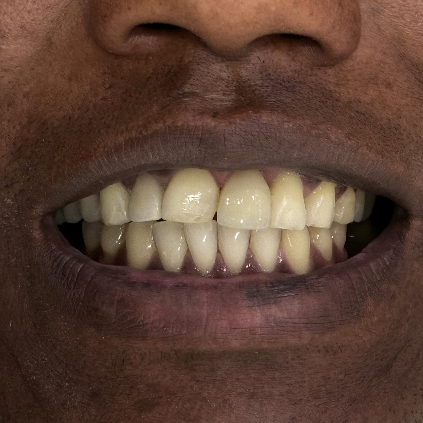 Implante Dentário