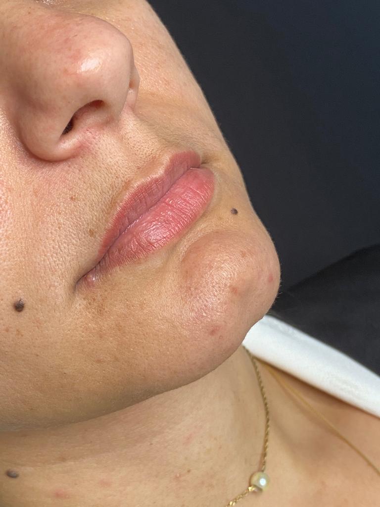 Antes — Preenchimento labial
