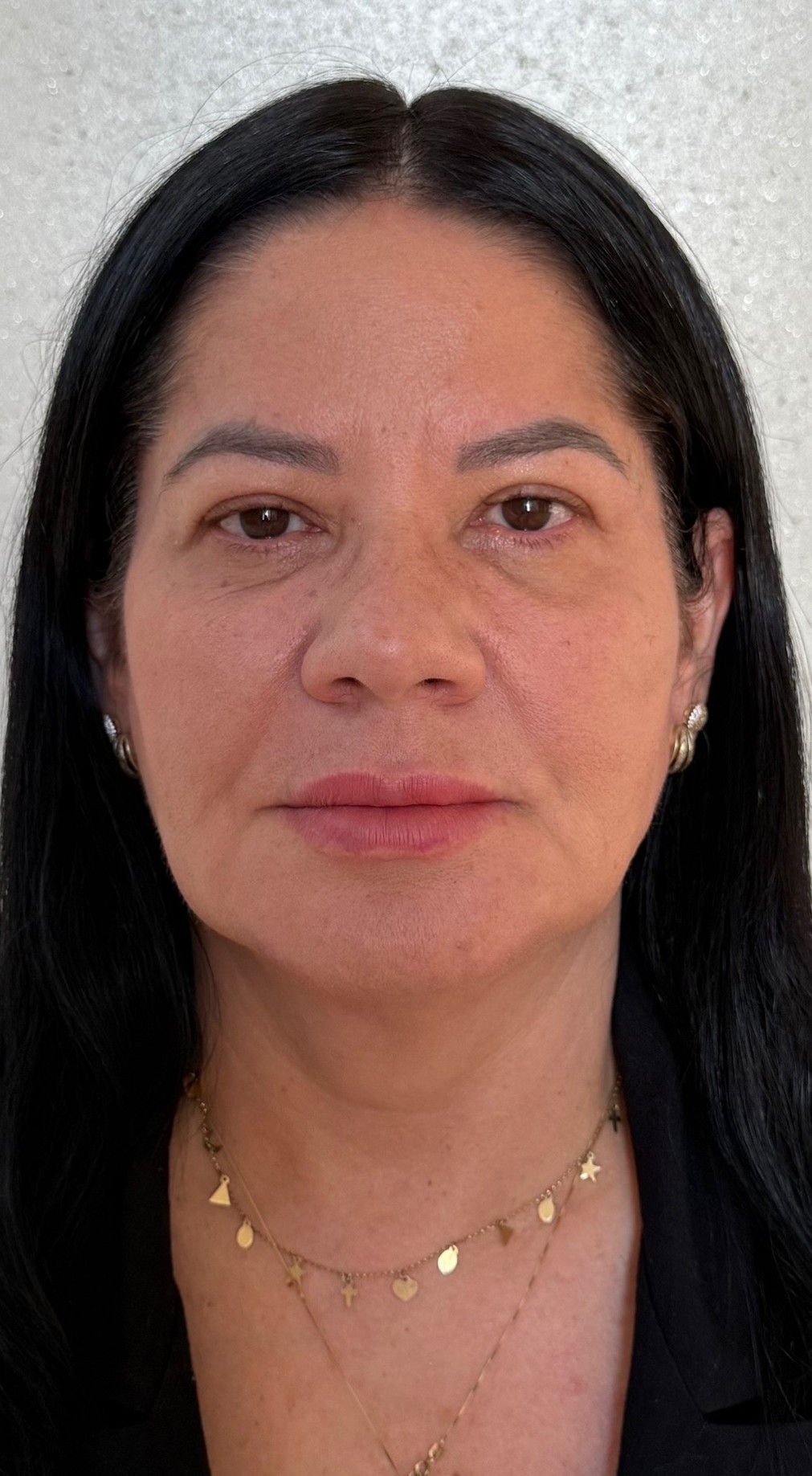 Harmonização Facial