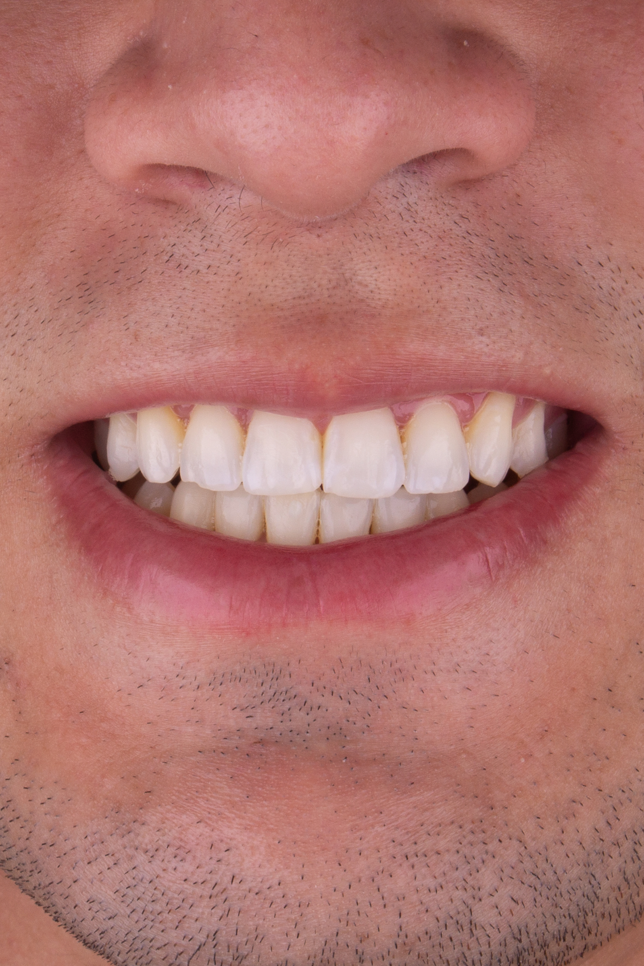Clareamento Dental