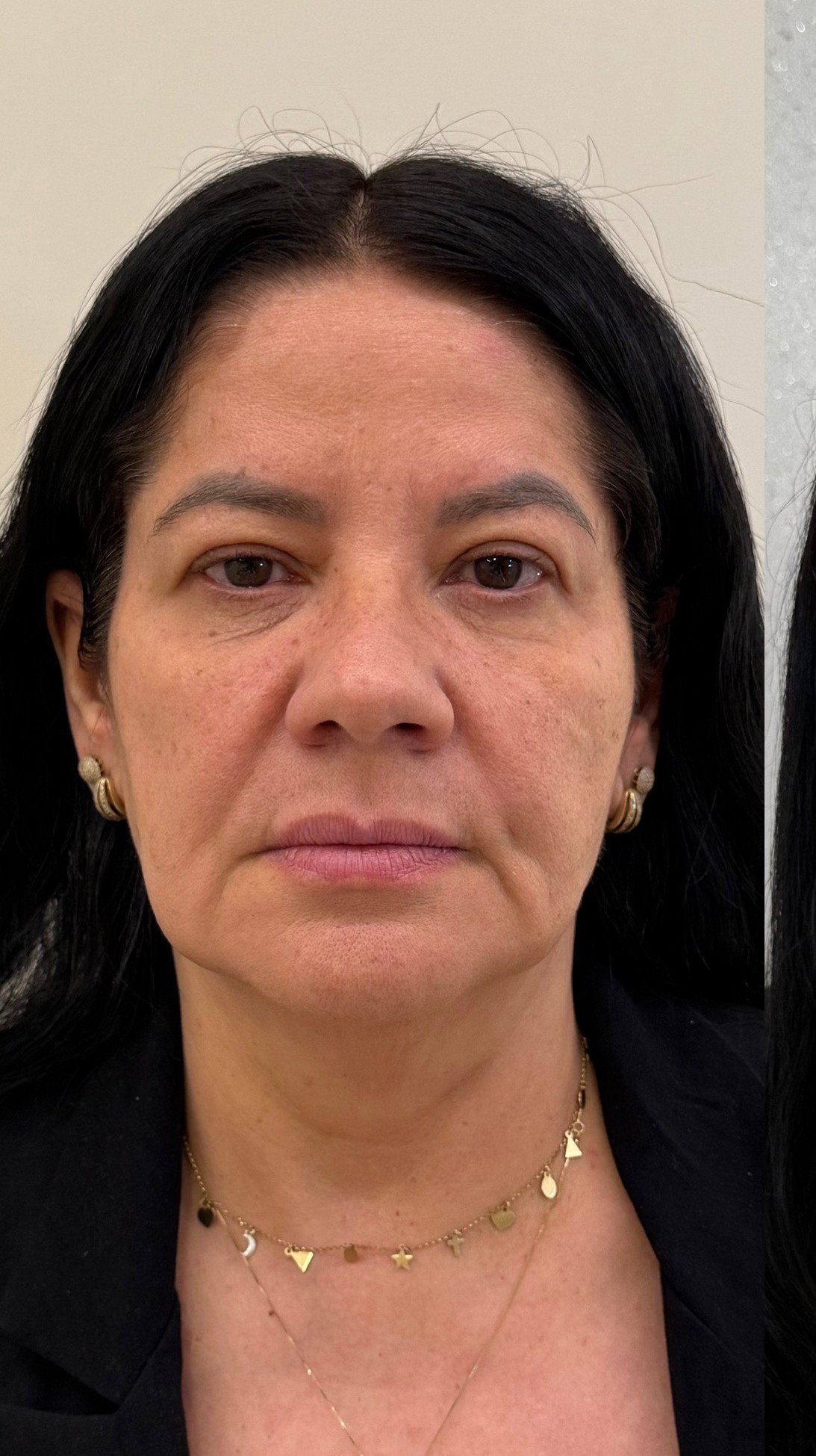 Antes — Harmonização facial