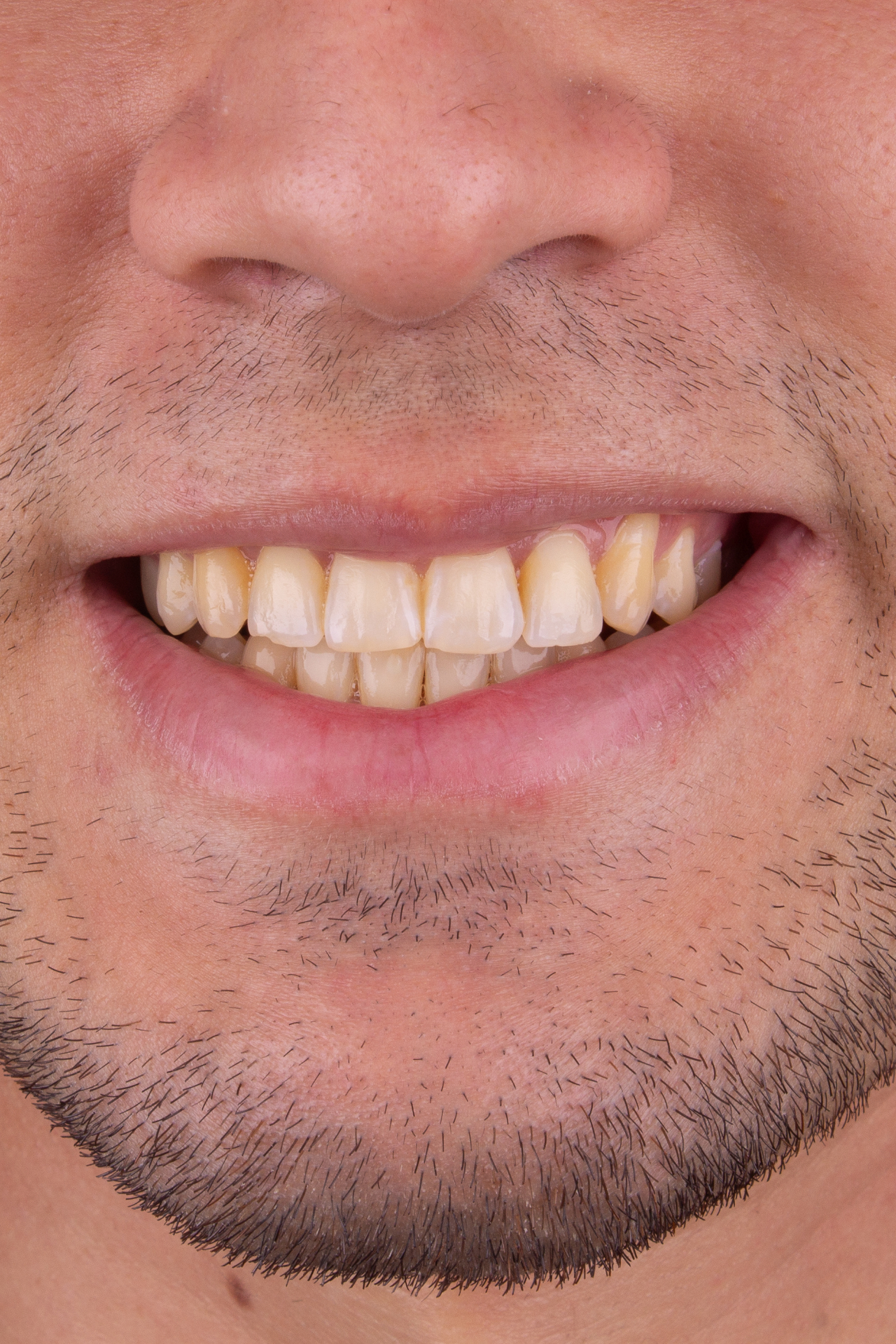 Antes — Clareamento dental